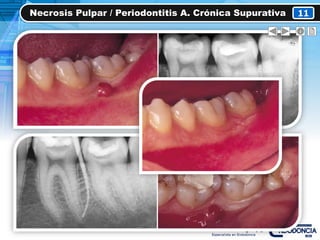 Necrosis Pulpar / Periodontitis A. Crónica Supurativa 11
 
