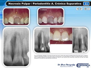 Necrosis Pulpar / Periodontitis A. Crónica Supurativa 11
1 semana
1 año
 