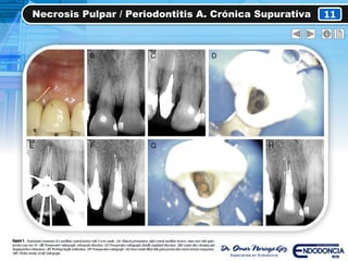 Necrosis Pulpar / Periodontitis A. Crónica Supurativa 11
 