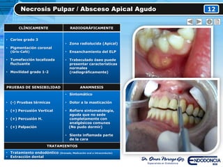 Necrosis Pulpar / Absceso Apical Agudo 12
CLÍNICAMENTE RADIOGRÁFICAMENTE
• Caries grado 3
• Pigmentación coronal
(Gris-Café)
• Tumefacción localizada
fluctuante
• Movilidad grado 1-2
• Zona radiolucida (Apical)
• Ensanchamiento del ELP
• Trabeculado óseo puede
presentar características
normales
(radiográficamente)
PRUEBAS DE SENSIBILIDAD ANAMNESIS
• (-) Pruebas térmicas
• (+) Percusión Vertical
• (+) Percusión H.
• (+) Palpación
• Sintomático
• Dolor a la masticación
• Refiere sintomatología,
aguda que no sede
completamente con
analgésicos comunes
(No pudo dormir)
• Siente inflamada parte
de la cara
TRATAMIENTOS
• Tratamiento endodóntico (Drenado, Medicación oral e intraconducto)
• Extracción dental
 