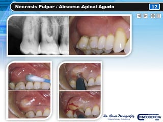 Necrosis Pulpar / Absceso Apical Agudo 12
 