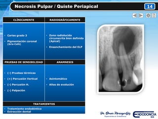Necrosis Pulpar / Quiste Periapical 14
CLÍNICAMENTE RADIOGRÁFICAMENTE
• Caries grado 3
• Pigmentación coronal
(Gris-Café)
• Zona radiolucida
circunscrita bien definida
(Apical)
• Ensanchamiento del ELP
PRUEBAS DE SENSIBILIDAD ANAMNESIS
• (-) Pruebas térmicas
• (+) Percusión Vertical
• (-) Percusión H.
• (-) Palpación
• Asintomático
• Años de evolución
TRATAMIENTOS
• Tratamiento endodóntico
• Extracción dental
 