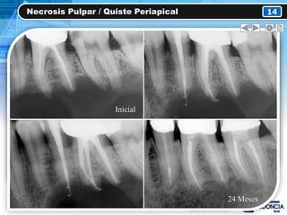 Necrosis Pulpar / Quiste Periapical 14
Inicial
24 Meses
 
