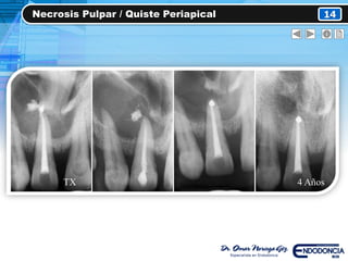 Necrosis Pulpar / Quiste Periapical 14
TX 4 Años
 