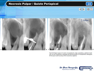 Necrosis Pulpar / Quiste Periapical 14
2 Años
 