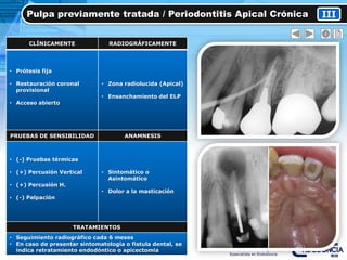 Pulpa previamente tratada / Periodontitis Apical Crónica III
CLÍNICAMENTE RADIOGRÁFICAMENTE
• Prótesis fija
• Restauración coronal
provisional
• Acceso abierto
• Zona radiolucida (Apical)
• Ensanchamiento del ELP
PRUEBAS DE SENSIBILIDAD ANAMNESIS
• (-) Pruebas térmicas
• (+) Percusión Vertical
• (+) Percusión H.
• (-) Palpación
• Sintomático o
Asintomático
• Dolor a la masticación
TRATAMIENTOS
• Seguimiento radiográfico cada 6 meses
• En caso de presentar sintomatología o fistula dental, se
indica retratamiento endodóntico o apicectomia
 