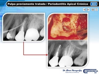 IIIPulpa previamente tratada / Periodontitis Apical Crónica
 