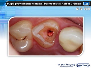 IIIPulpa previamente tratada / Periodontitis Apical Crónica
 