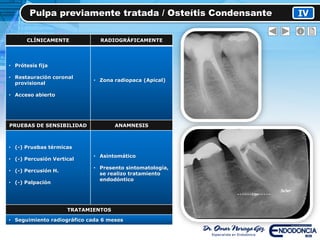 IV
CLÍNICAMENTE RADIOGRÁFICAMENTE
• Prótesis fija
• Restauración coronal
provisional
• Acceso abierto
• Zona radiopaca (Apical)
PRUEBAS DE SENSIBILIDAD ANAMNESIS
• (-) Pruebas térmicas
• (-) Percusión Vertical
• (-) Percusión H.
• (-) Palpación
• Asintomático
• Presento sintomatología,
se realizo tratamiento
endodóntico
TRATAMIENTOS
• Seguimiento radiográfico cada 6 meses
Pulpa previamente tratada / Osteítis Condensante
 