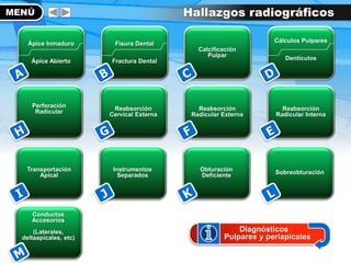 Cálculos Pulpares
Dentículos
Transportación
Apical
Instrumentos
Separados
Obturación
Deficiente
Perforación
Radicular Reabsorción
Cervical Externa
Reabsorción
Radicular Externa
Fisura Dental
Fractura Dental
Ápice Inmaduro
Ápice Abierto
Calcificación
Pulpar
Reabsorción
Radicular Interna
MENÚ Hallazgos radiográficos
Sobreobturación
Diagnósticos
Pulpares y periapicales
Conductos
Accesorios
(Laterales,
deltaapicales, etc)
 