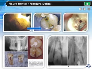 Fisura Dental / Fractura Dental B
 