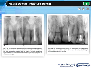 Fisura Dental / Fractura Dental B
 