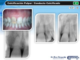 Calcificación Pulpar / Conducto Calcificado C
 
