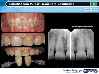 Calcificación Pulpar / Conducto Calcificado C
 