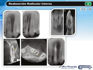 Reabsorción Radicular Interna E
 