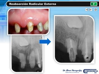 Reabsorción Radicular Externa F
 