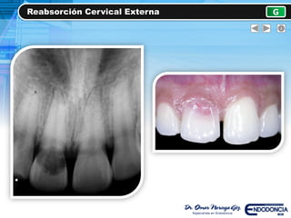 Reabsorción Cervical Externa G
Virus herpes felino FEHV-1
 