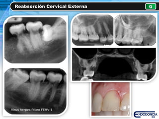 Reabsorción Cervical Externa G
Virus herpes felino FEHV-1
 