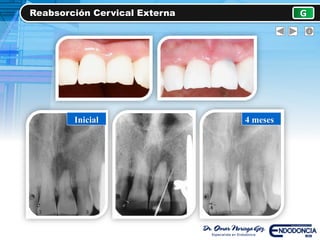 Reabsorción Cervical Externa G
4 mesesInicial
 