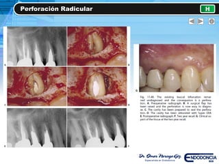 Perforación Radicular H
 