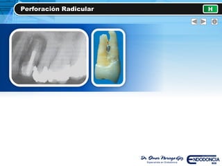 Perforación Radicular H
 