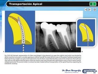 Transportación Apical I
 