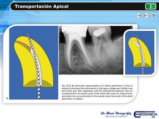 Transportación Apical I
 