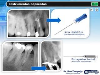 Instrumentos Separados J
Lima Hedström
(Retratamiento endodóntico)
Portapastas Lentulo
(Medicación intraconducto)
 