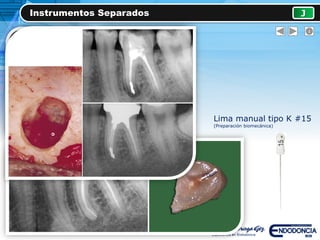 Instrumentos Separados J
Lima manual tipo K #15
(Preparación biomecánica)
 