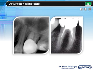 Obturación Deficiente K
 