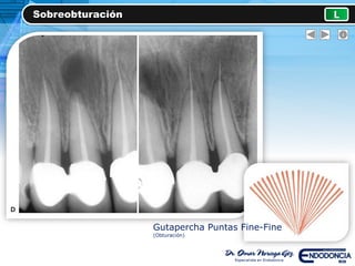 Sobreobturación L
Gutapercha Puntas Fine-Fine
(Obturación)
 