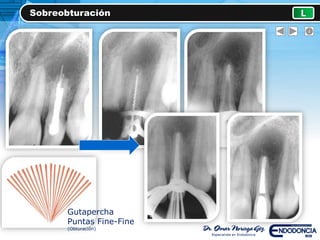 Sobreobturación L
Gutapercha
Puntas Fine-Fine
(Obturación)
 
