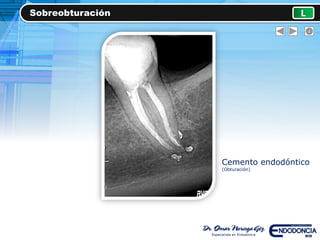 Sobreobturación L
Cemento endodóntico
(Obturación)
 