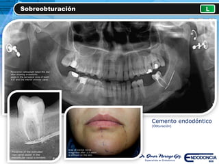 Sobreobturación L
Cemento endodóntico
(Obturación)
Panoramic radiograph taken the day
after showing endodontic
paste in the periapical zone of tooth
#37 and the inferior alveolar canal.
Area of mental nerve
anesthesia after 3.5 years
is outlined on the skin.
Presence of the extruded
root canal sealer in the
mandibular canal is evident.
 