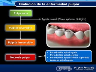 Evolución de la enfermedad pulpar
Pulpa sana
Pulpitis reversible
Pulpitis irreversible
Necrosis pulpar
Agente causal (Físico, químico, biológico)
• Periodontitis apical aguda
• Periodontitis apical crónica
• Periodontitis apical crónica supurativa
• Absceso apical agudo
 