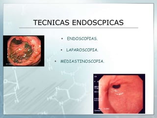 TECNICAS ENDOSCPICAS
 ENDOSCOPIAS.
 LAPAROSCOPIA.
 MEDIASTINOSCOPIA.
 
