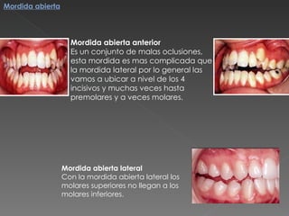 Mordida abierta anterior Es un conjunto de malas oclusiones, esta mordida es mas complicada que la mordida lateral por lo general las vamos a ubicar a nivel de los 4 incisivos y muchas veces hasta premolares y a veces molares. Mordida abierta lateral Con la mordida abierta lateral los molares superiores no llegan a los molares inferiores. Mordida abierta 