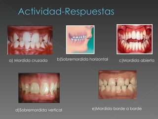 a) Mordida cruzada b)Sobremordida horizontal c)Mordida abierta d)Sobremordida vertical e)Mordida borde a borde 