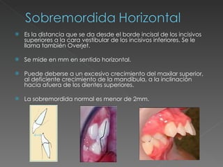 Es la distancia que se da desde el borde incisal de los incisivos superiores a la cara vestibular de los incisivos inferiores. Se le llama también Overjet. Se mide en mm en sentido horizontal. Puede deberse a un excesivo crecimiento del maxilar superior, al deficiente crecimiento de la mandíbula, a la inclinación hacia afuera de los dientes superiores. La sobremordida normal es menor de 2mm. 