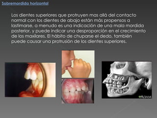 Los dientes superiores que protruyen mas allá del contacto normal con los dientes de abajo están más propensos a lastimarse, a menudo es una indicación de una mala mordida posterior, y puede indicar una desproporción en el crecimiento de los maxilares. El hábito de chuparse el dedo, también puede causar una protrusión de los dientes superiores. Sobremordida horizontal 