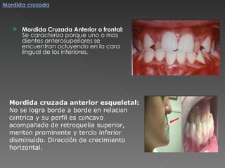 Mordida Cruzada Anterior o frontal: Se caracteriza porque uno o mas dientes anterosuperiores se encuentran ocluyendo en la cara lingual de los inferiores. Mordida cruzada anterior esqueletal: No se logra borde a borde en relaci ó n c é ntrica y su perfil es c ó ncavo acompa ñ ado de retroquelia superior, ment ó n prominente y tercio inferior disminuido. Dirección de crecimiento horizontal.   Mordida cruzada 