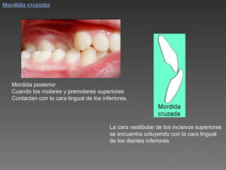 Mordida posterior Cuando los molares y premolares superiores Contactan con la cara lingual de los inferiores. La cara vestibular de los incisivos superiores  se encuentra ocluyendo con la cara lingual  de los dientes inferiores Mordida cruzada 