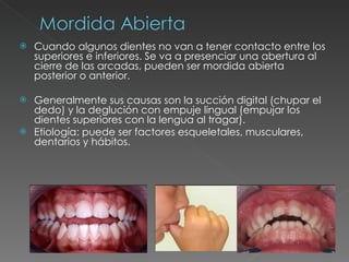 Cuando algunos dientes no van a tener contacto entre los superiores e inferiores. Se va a presenciar una abertura al cierre de las arcadas, pueden ser mordida abierta posterior o anterior. Generalmente sus causas son la succión digital (chupar el dedo) y la deglución con empuje lingual (empujar los dientes superiores con la lengua al tragar). Etiología: puede ser factores esqueletales, musculares, dentarios y hábitos. 