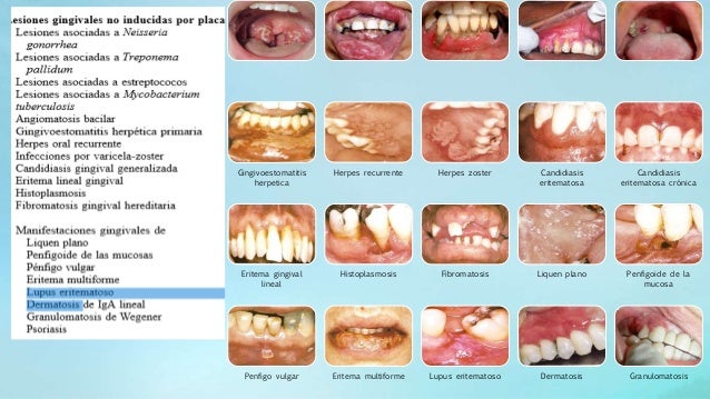Diagnostico y clasificación de las enfermedades periodontales
