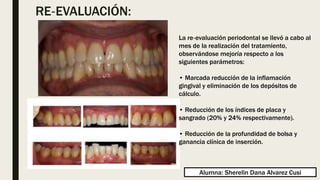 RE‐EVALUACIÓN:
La re‐evaluación periodontal se llevó a cabo al
mes de la realización del tratamiento,
observándose mejoría respecto a los
siguientes parámetros:
• Marcada reducción de la inflamación
gingival y eliminación de los depósitos de
cálculo.
• Reducción de los índices de placa y
sangrado (20% y 24% respectivamente).
• Reducción de la profundidad de bolsa y
ganancia clínica de inserción.
Alumna: Sherelin Dana Alvarez Cusi
 