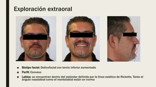 Exploración extraoral
■ Biotipo facial: Dolicofacial con tercio inferior aumentado
■ Perfil: Convexo
■ Labios: se encuentran dentro del estándar definido por la línea estética de Ricketts. Tanto el
ángulo nasolabial como el mentolabial están en norma
 