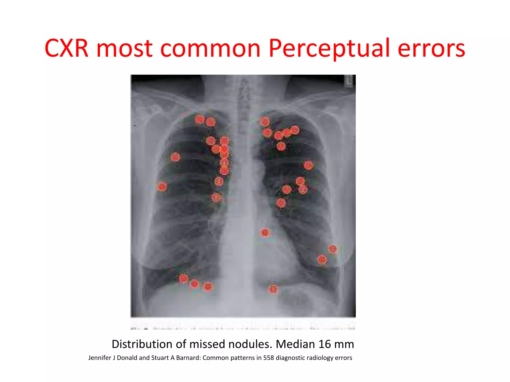 CXR most common Perceptual errors
Distribution of missed nodules. Median 16 mm
Jennifer J Donald and Stuart A Barnard: Common patterns in 558 diagnostic radiology errors
 