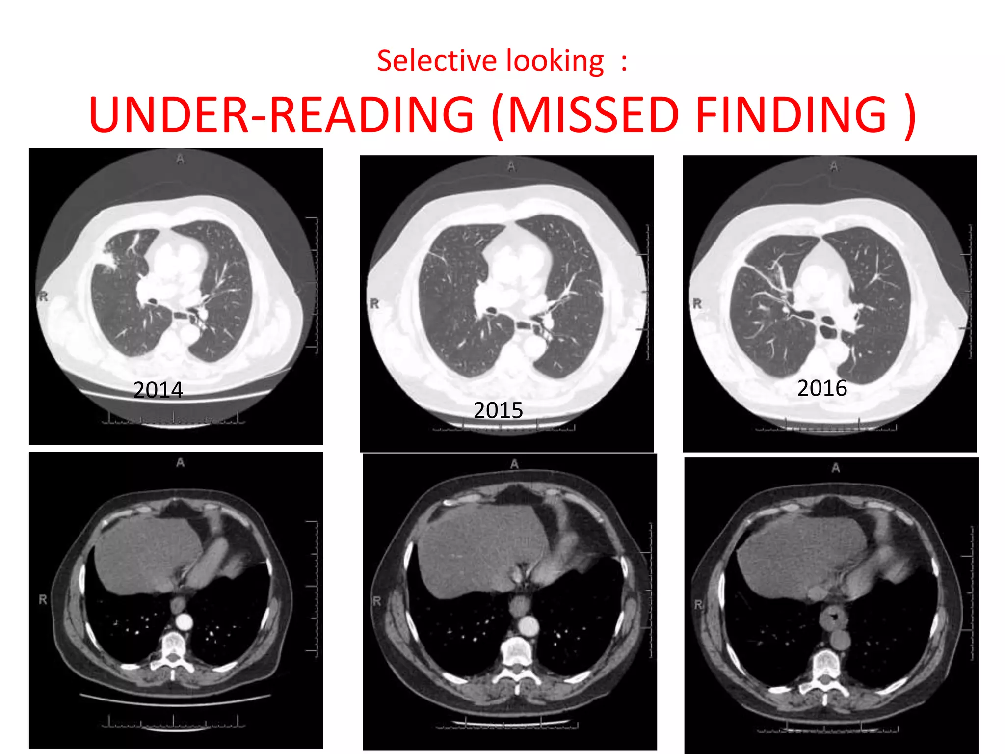 Selective looking :
UNDER-READING (MISSED FINDING )
2014
2015
2016
 