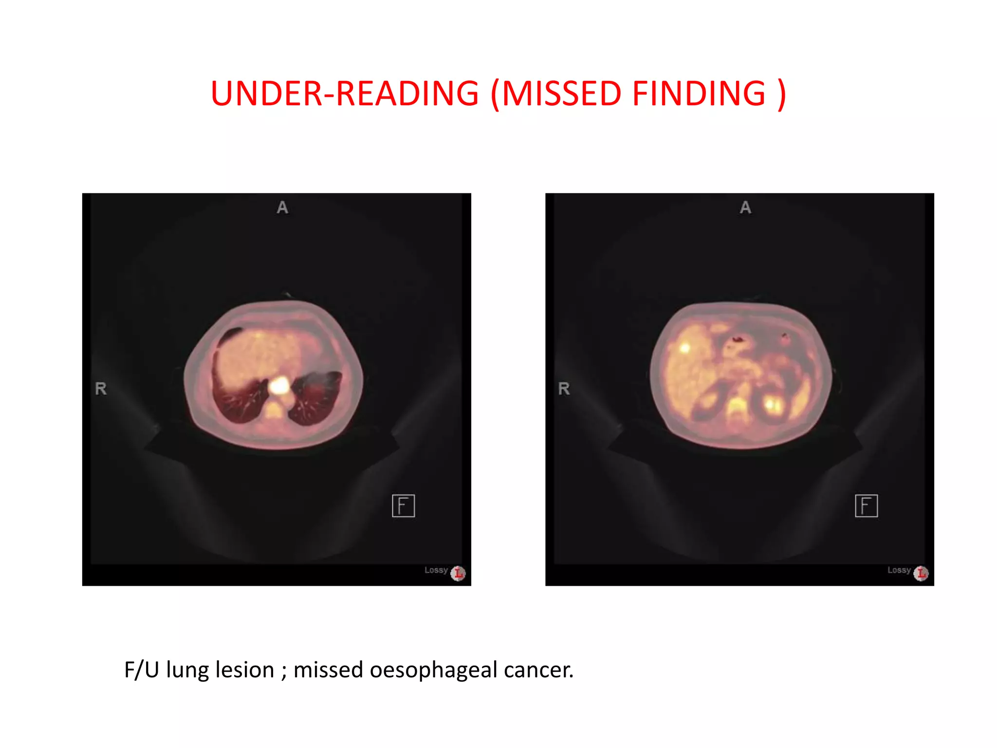 UNDER-READING (MISSED FINDING )
F/U lung lesion ; missed oesophageal cancer.
 