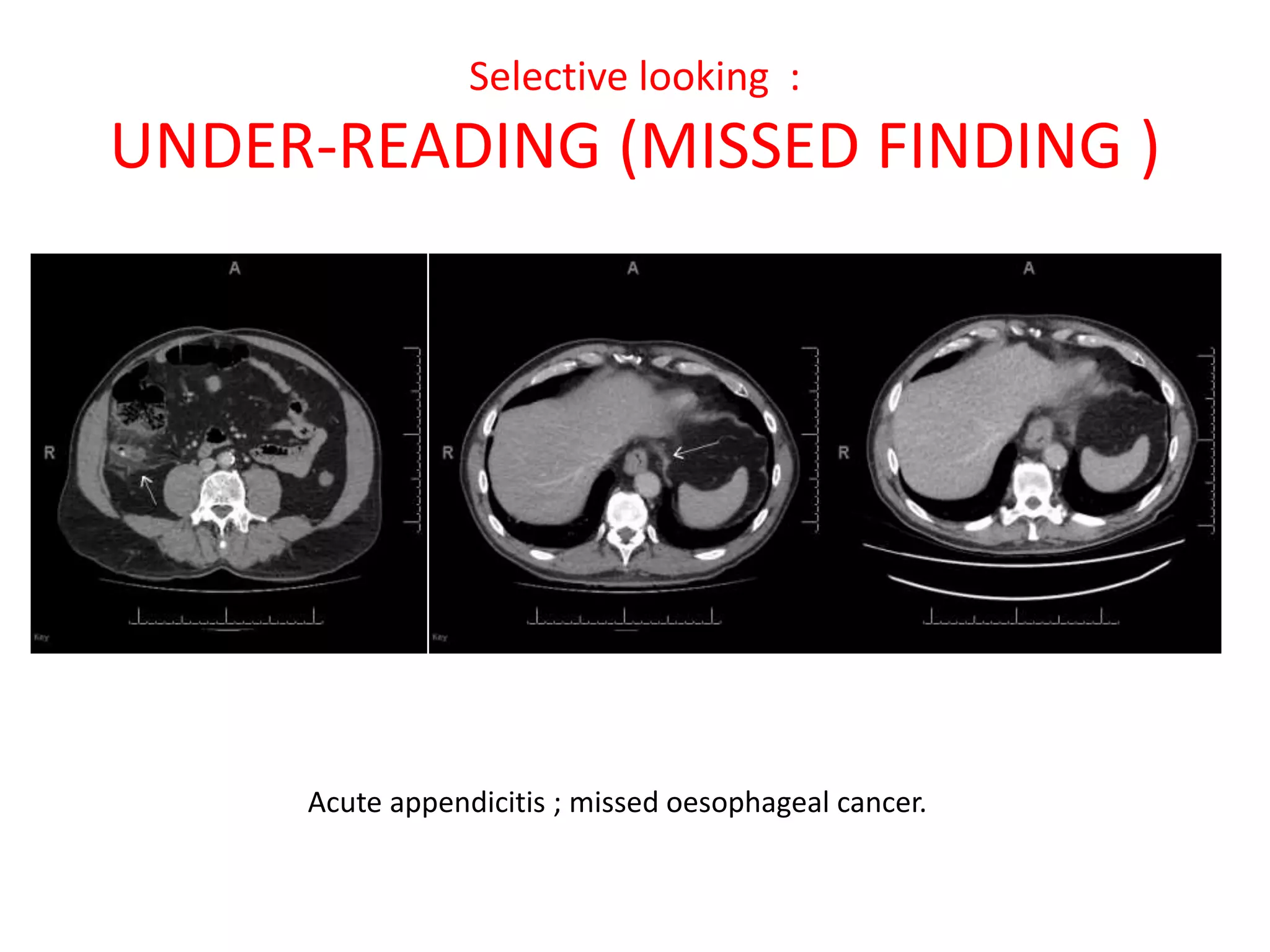 Selective looking :
UNDER-READING (MISSED FINDING )
Acute appendicitis ; missed oesophageal cancer.
 
